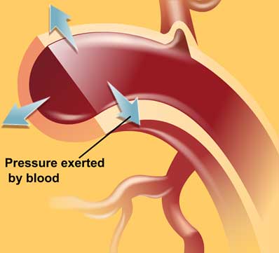 Hypertension - Dr. VT Shah